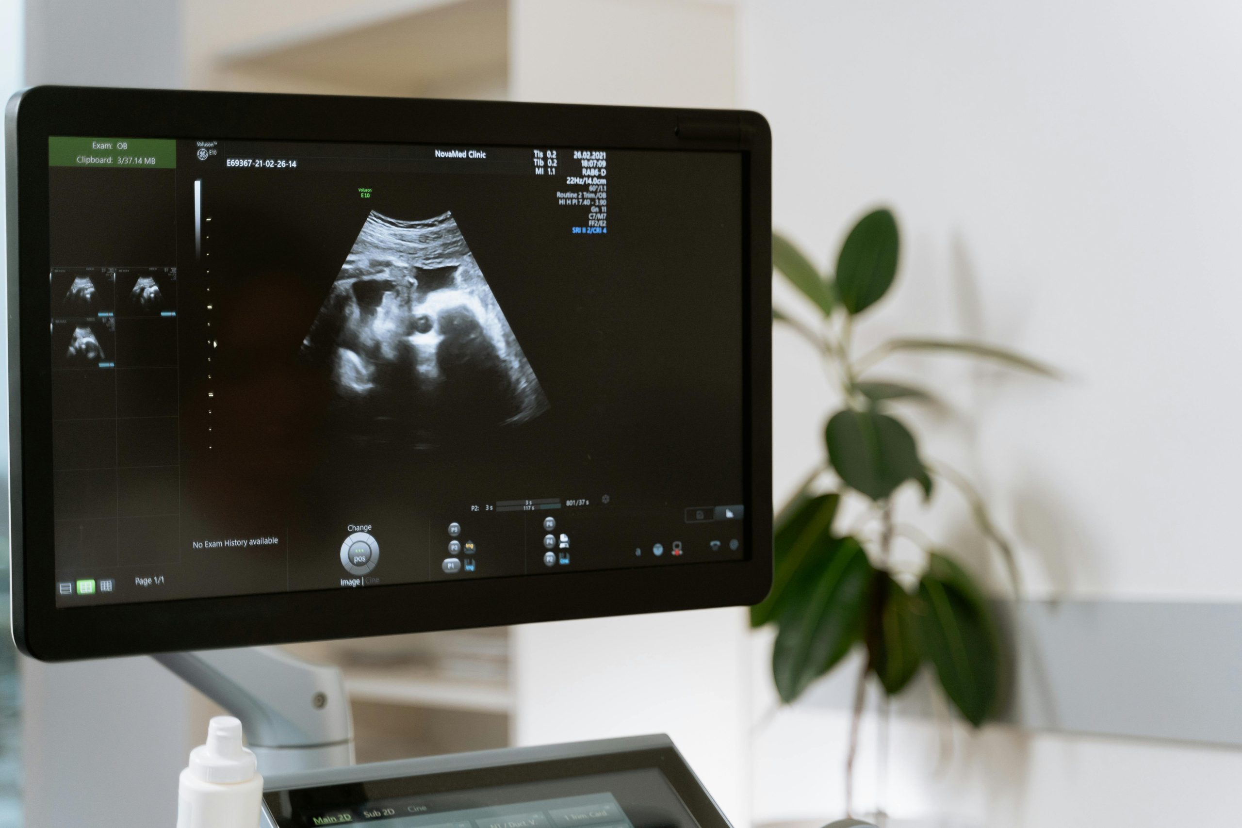 A medical ultrasound machine screen displaying an obstetric ultrasound scan in a clinic room.